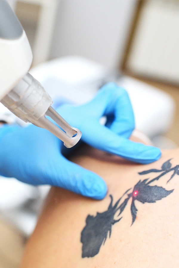 Tattoo removal result